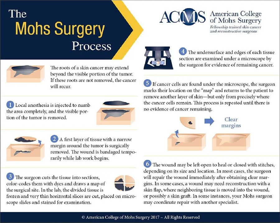 Mohs Surgery Process